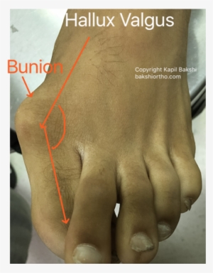 Hallux Valgus With Bunion And Overlapping Toes - Poster