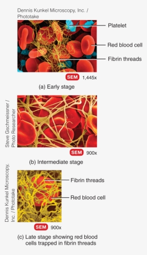 It Consists Of A Network Of Insoluble Protein Fibers - Pathophysiology Of Blood Disorders By Howard Franklin