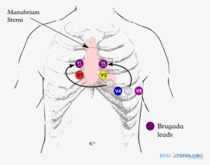 Brugada Lead Placement - Brugada Syndrome Ecg Placement