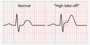 This Normal Variant Of The Ecg Represents Early Repolarisation - Normal Ecg Vs St Elevation