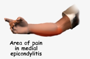 You May Feel Less Strength When Grasping Items Or Squeezing - Medial Epicondylitis Golfer's Elbow