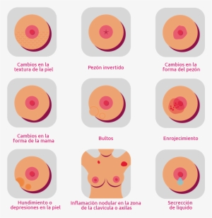 ¿cuáles Son Los Síntomas Del Cáncer De Mama - Swelling Breast