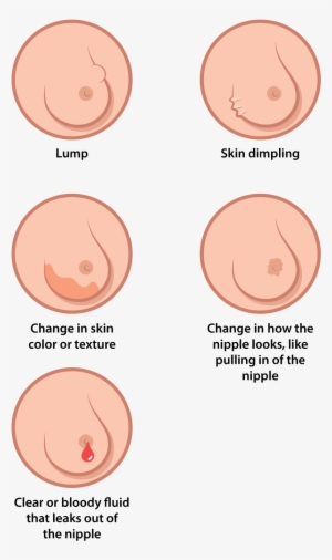 Open - Signs And Symptoms Of Breast Cancers
