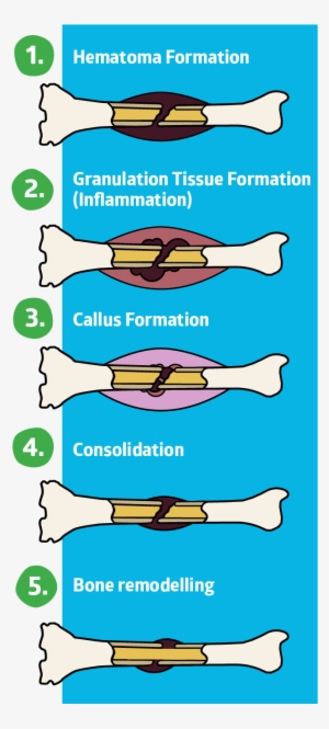 Hematoma Formation - Fracture Healing Stages