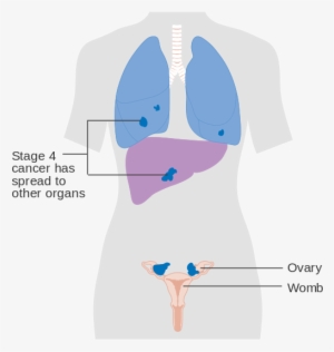 Diagram Showing Stage 4 Ovarian Cancer Cruk - Ovaries And Liver