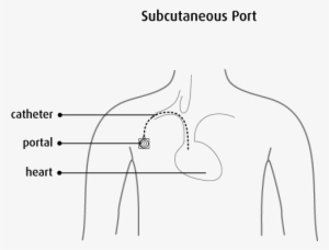 The Nurse Inserts A Special Type Of Needle Through - Subcutaneous Port Catheter