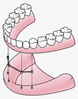 Implant-istock 51362490 Illustration - Component Of Partial Denture