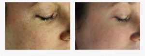 Suttonderm Beforeaftergallery Fraxel3 - Fraxel Laser