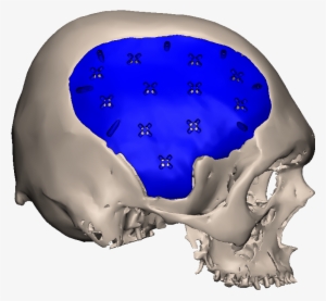 Side-psi - Cranial Prosthesis Pmma