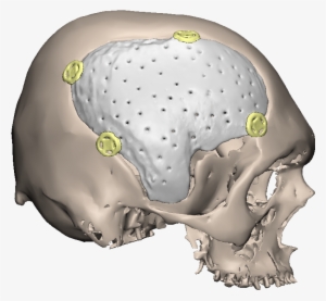 Side-pmma - Cranial Prosthesis Pmma