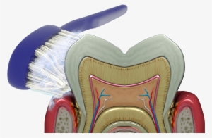 Brushing, Rinsing And Flossing Cannot Reach The Bacteria - Gingival And Periodontal Pocket
