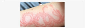 Erythema And Inflammation On The Left Forearm Of A - Inflammation
