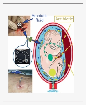 Hypoosmotic Saline Solution With Antibiotic Used To - Amnioinfusion