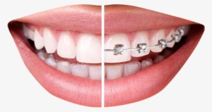 Teeth With Braces Png Transparent Image - Dientes Con Brackets