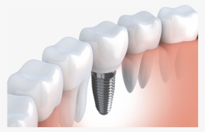 Dental Implants 1 - Implante De Muelas
