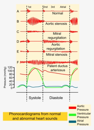 Phonocardiograms From Normal And Abnormal Heart Sounds