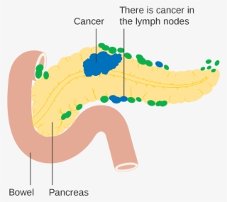 Open - Pancreatic Cancer Diagram