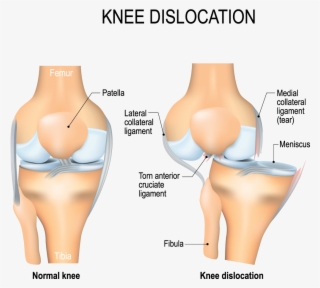 Acl Injury Physiotherapy Treatment - Knee Dislocation