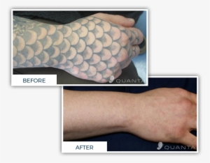 affordable & effective laser tattoo removal - laser tattoo removal before and after 2018