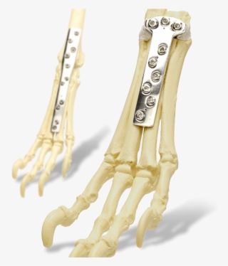 Mmp Sop Ridgestop Carpal Arthodesis - Bone