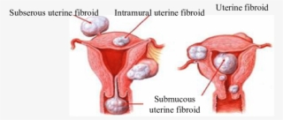 Types Of The Patients' Uterine Fibroids Table - Fibroid Uterus Types