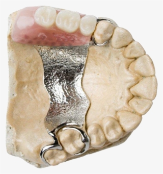 Complete & Partial Dentures, Dentures - Cobalt Chrome Denture Upper ...