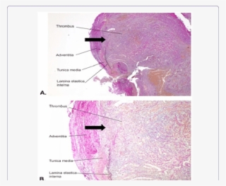 Transverse Section Of The Pseudoaneurysm - Pseudoaneurysm