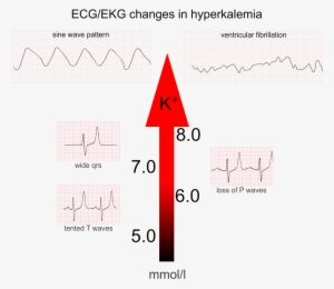 Hyperkalemia6 - Diagram