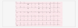 Admission Ekg With Q-waves In The Inferior Leads And - Number