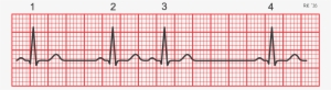Electrocardiogram Rhythm Strip - Irregular Heart Rate Ecg