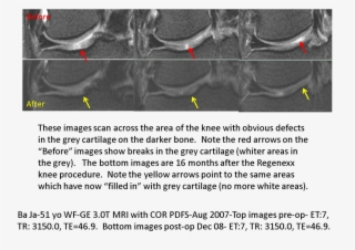 Note The Red Arrows Point To Breaks In The Cartilage - Knee