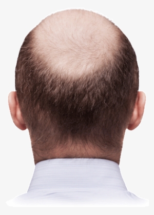 Slow, Stop, And Reverse Your Hair Loss - Bald Man Back Of Head