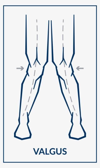 Use The Allen Wrench Provided For Minor Varus/valgus - Art