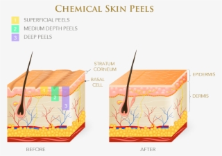 chemical peels come in different strengths, and the - oily & dry skin