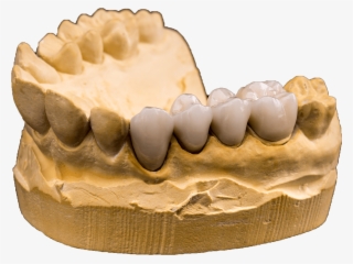 Check Out What Others Are Saying About Our Dental Crown - Ceramic