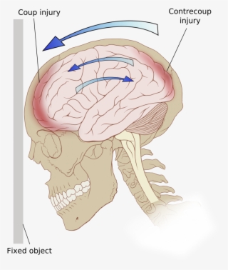Prevalence - Traumatic Brain Injury