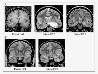 Selected Mr Images Of Patients In The Early Amygdala