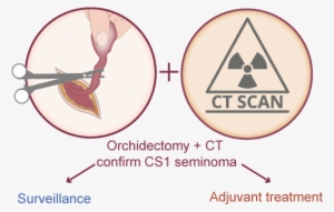 Management Of Clinical Stage 1 Seminoma With Surveillance - Circle