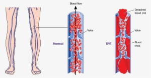 What Is Deep Vein Thrombosis - Dvt Pulmonary Embolism