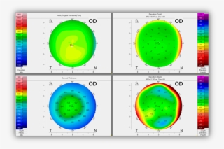 4 Maps Refactive Of The Stable Right Eye