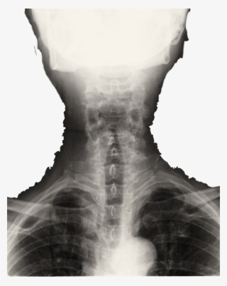 Photodune 3666446 Spinal Column Back Upper Part Xray