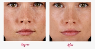 Before And After
