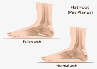 Flat Feet