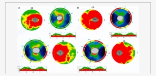 Optic Coherence Tomography