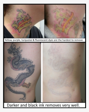 Laser Tattoo Removal In Milton Keynes - Tattoo Transparent PNG - 721x1000 -  Free Download on NicePNG
