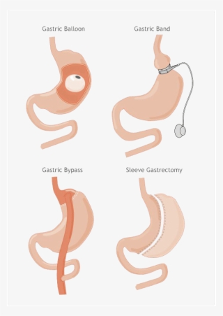 revision bariatric weight loss surgery - octopus