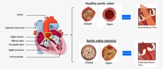 This Narrowing Can Become Severe Enough To Reduce Blood - Pannus Aortic Valve
