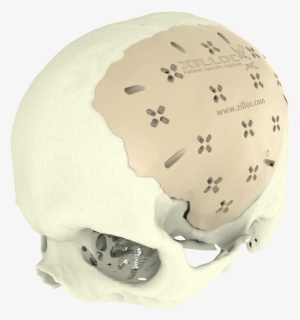 Cranial-implant - Implant