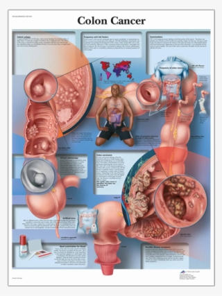Anatomical Chart - Colon Cancer - Colon Cancer Anatomy