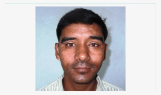 Insertion Of Ocular Prosthesis - Human